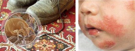 Наличие пылевых клещей в доме – это  серьезная угроза здоровью и самочувствию семьи